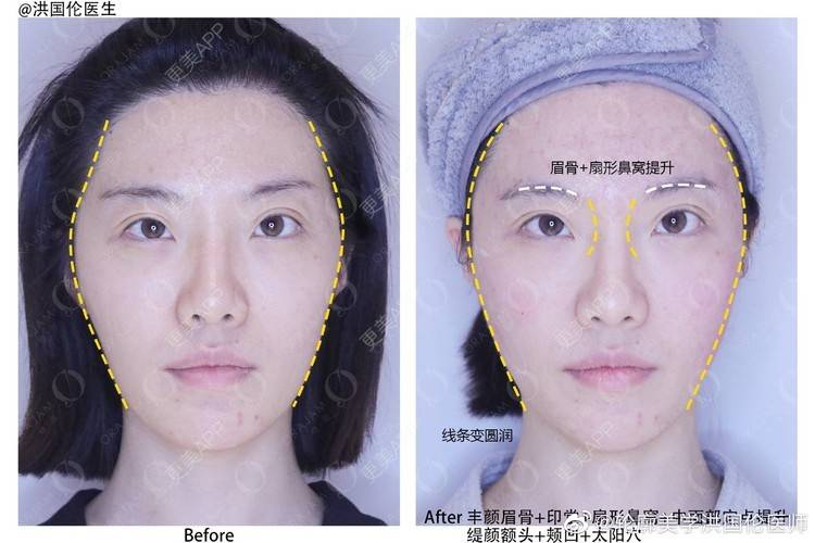 更美用户irjqo9vgpk的玻尿酸眉弓日记