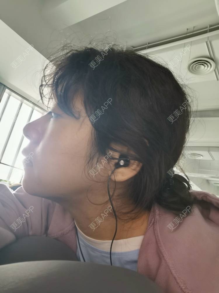 下巴截骨前移 | 上海 | 轮廓修复术 | 下颌角切除术