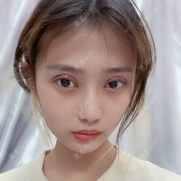 更美用户e2jdtq7mxd的全切双眼皮日记