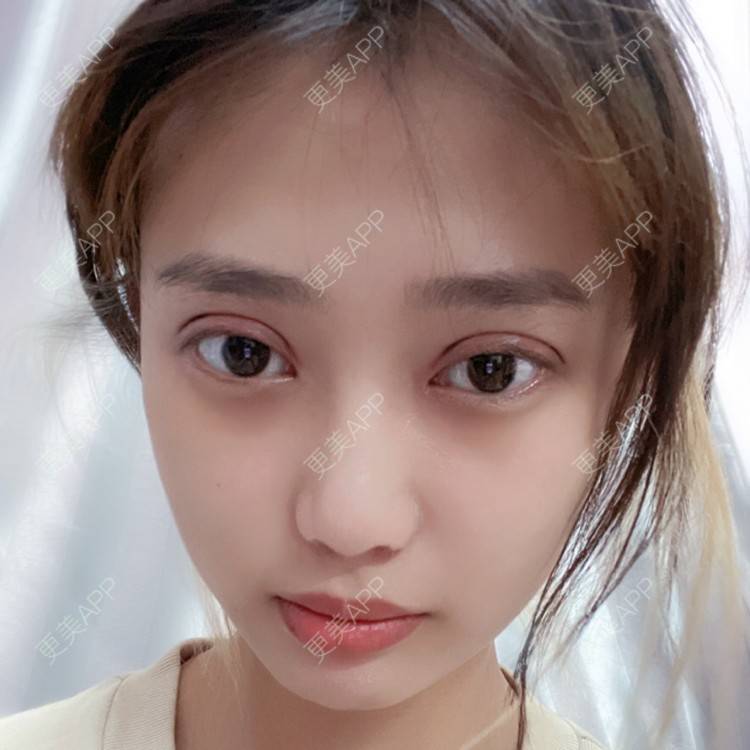 更美用户e2jdtq7mxd的全切双眼皮日记