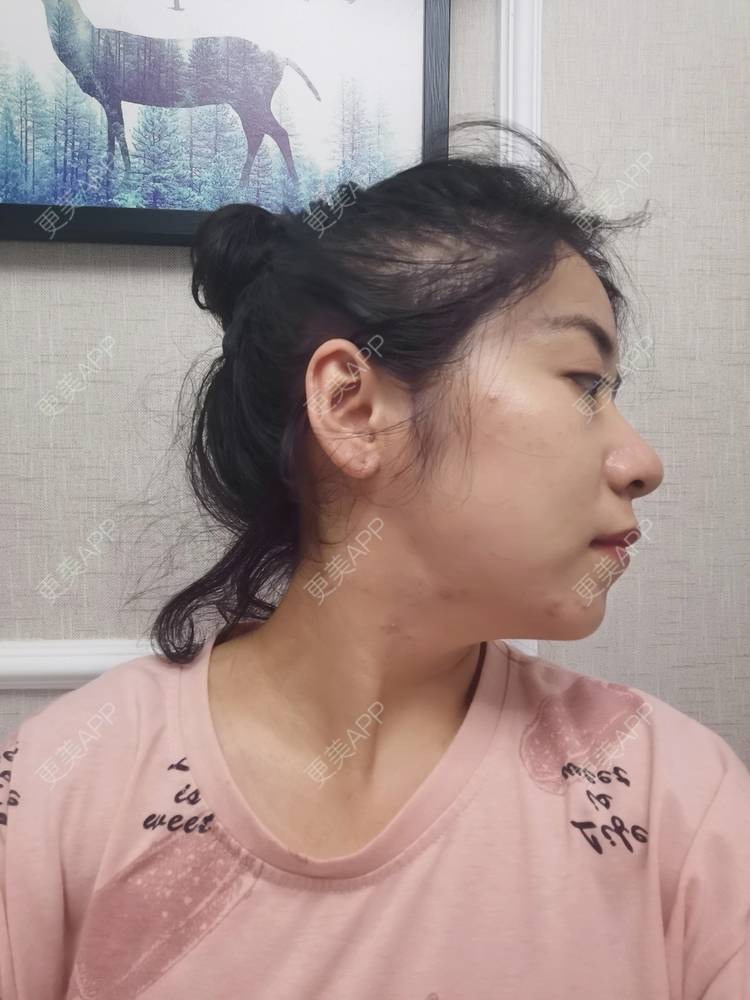 下巴截骨前移 | 上海 | 轮廓修复术 | 下颌角切除术