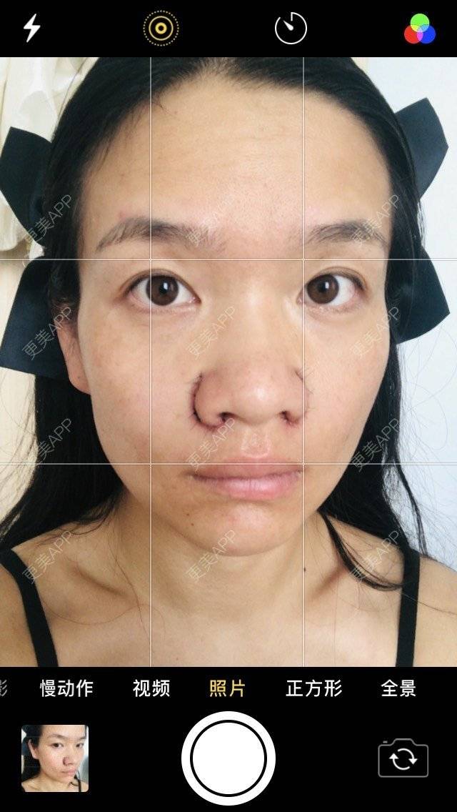 更美用户ahltypqim6的鼻翼缩小日记