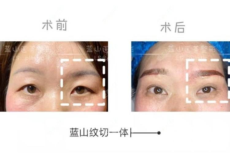 更美 - 保定市竞秀区蓝山医疗美容医院的隆鼻经验 | 切眉 | 隆鼻