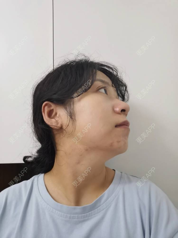 下巴截骨前移 | 上海 | 轮廓修复术 | 下颌角切除术