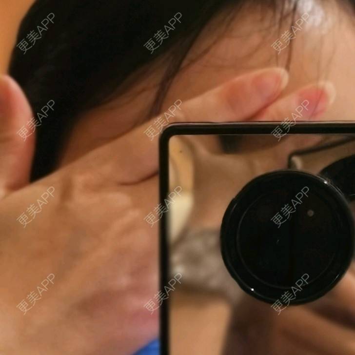 更美 - 更美用户5033869457的改善鱼尾纹经验 | 广州 | 改善鱼尾纹