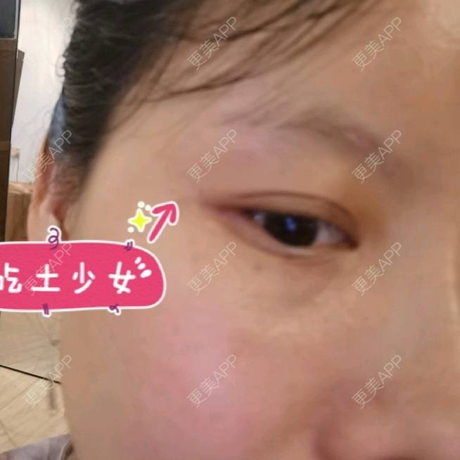 更美 - 更美用户5033869457的改善鱼尾纹经验 | 广州 | 改善鱼尾纹