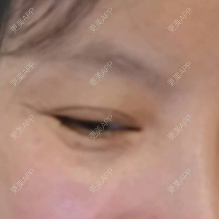 更美 - 更美用户5033869457的改善鱼尾纹经验 | 广州 | 改善鱼尾纹