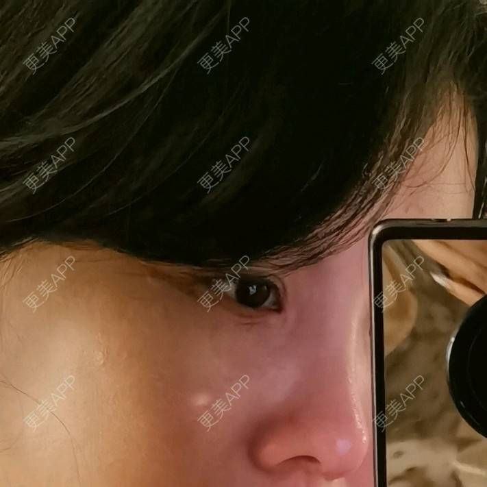 更美 - 更美用户5033869457的改善鱼尾纹经验 | 广州 | 改善鱼尾纹