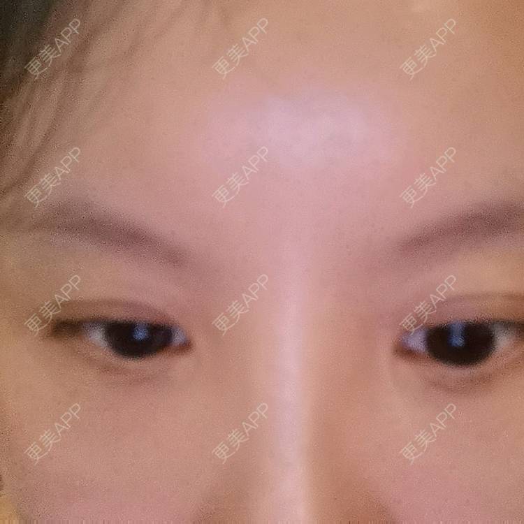 更美 - 更美用户5033869457的改善鱼尾纹经验 | 广州 | 改善鱼尾纹