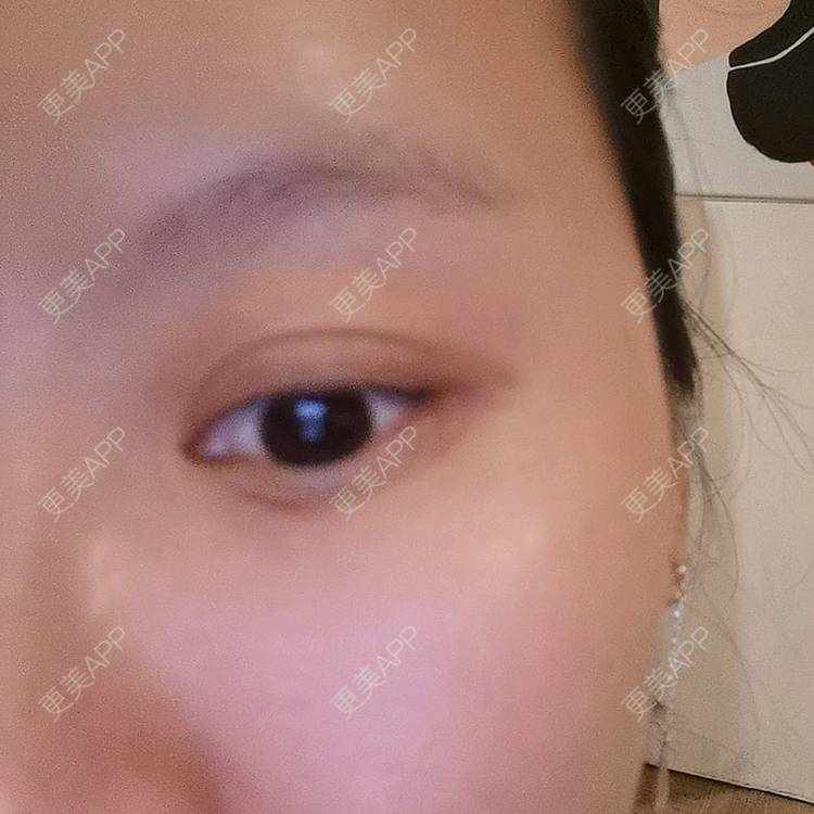 更美 - 更美用户5033869457的改善鱼尾纹经验 | 广州 | 改善鱼尾纹