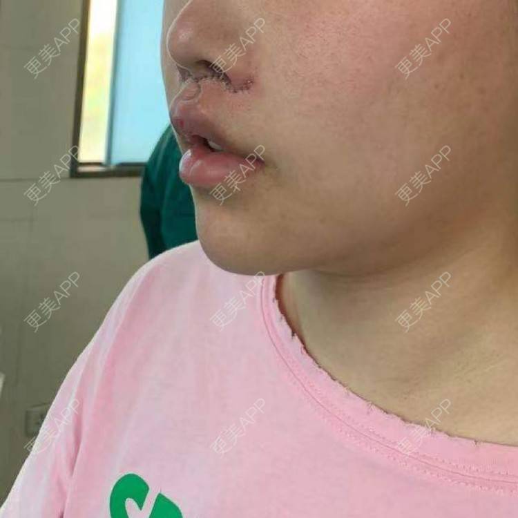 腭裂术后穿孔图片,腭裂术后瘘孔图片_大山谷图库
