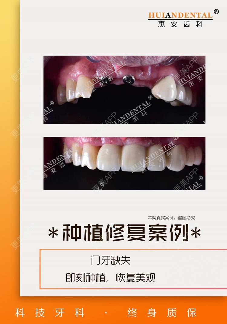 兰州种植牙齿价格多少钱一克(兰州种植牙齿价格多少钱一克啊)