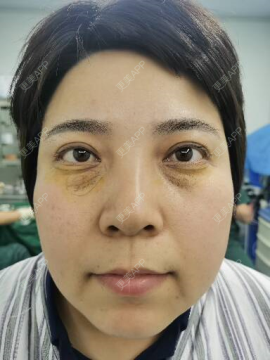 更美用户qdlctrlddh的外切去眼袋日记