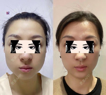 更美用户f656fajhpv的取颊脂垫瘦脸日记