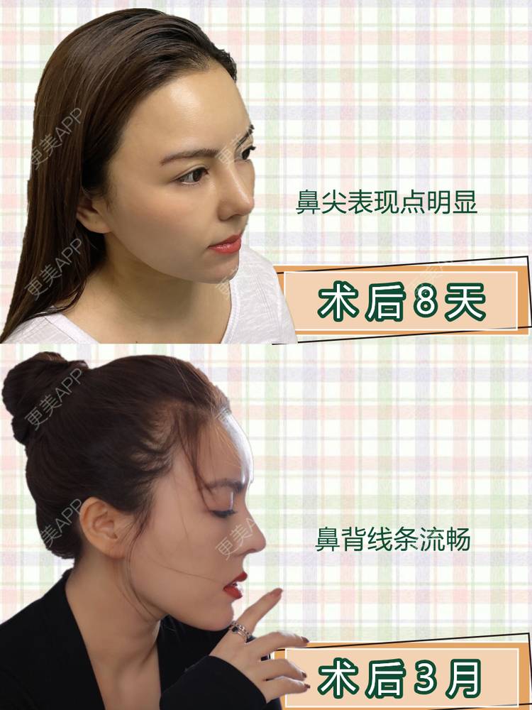 更美 - 李闯 医生的鼻部修复经验 | 鼻部修复