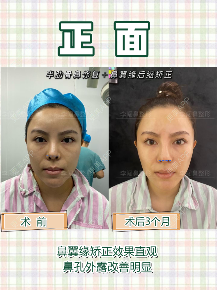 更美 - 李闯 医生的鼻部修复经验 | 鼻部修复