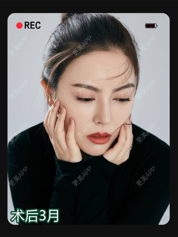 更美 - 李闯 医生的鼻部修复经验 | 鼻部修复