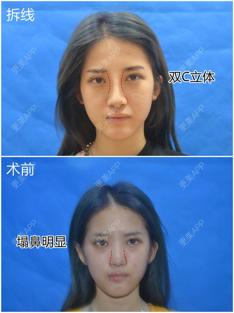 更美 - 李闯 医生的鼻中隔软骨隆鼻经验 | 鼻中隔软骨隆鼻