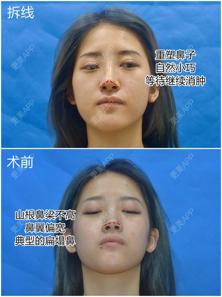 更美 - 李闯 医生的鼻中隔软骨隆鼻经验 | 鼻中隔软骨隆鼻