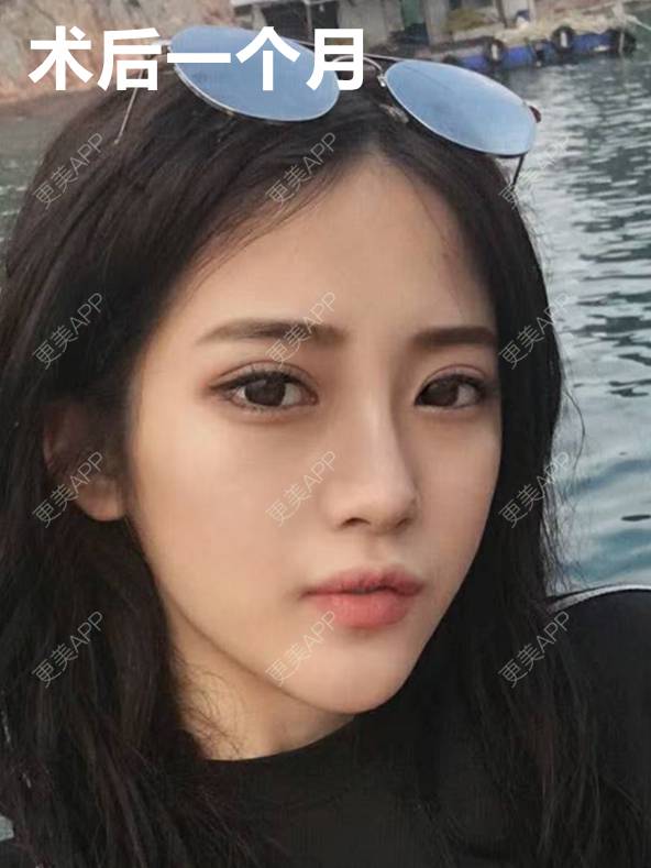 更美 - 李闯 医生的鼻中隔软骨隆鼻经验 | 鼻中隔软骨隆鼻