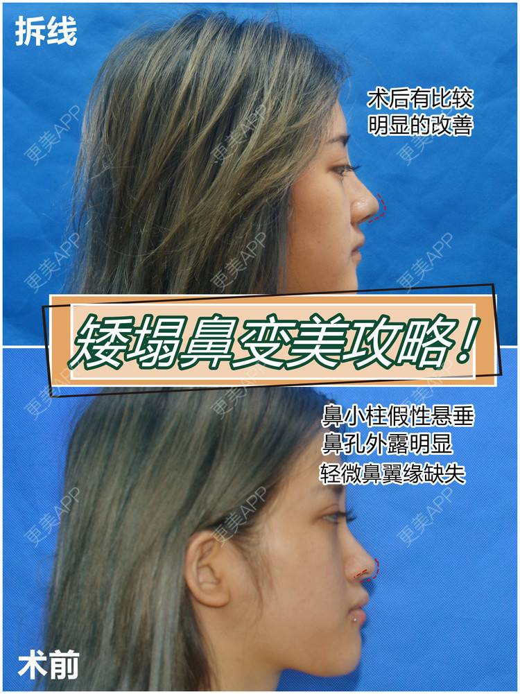 更美 - 李闯 医生的鼻中隔软骨隆鼻经验 | 鼻中隔软骨隆鼻