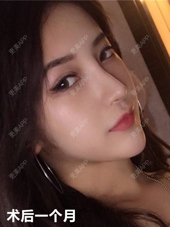 更美 - 李闯 医生的鼻中隔软骨隆鼻经验 | 鼻中隔软骨隆鼻