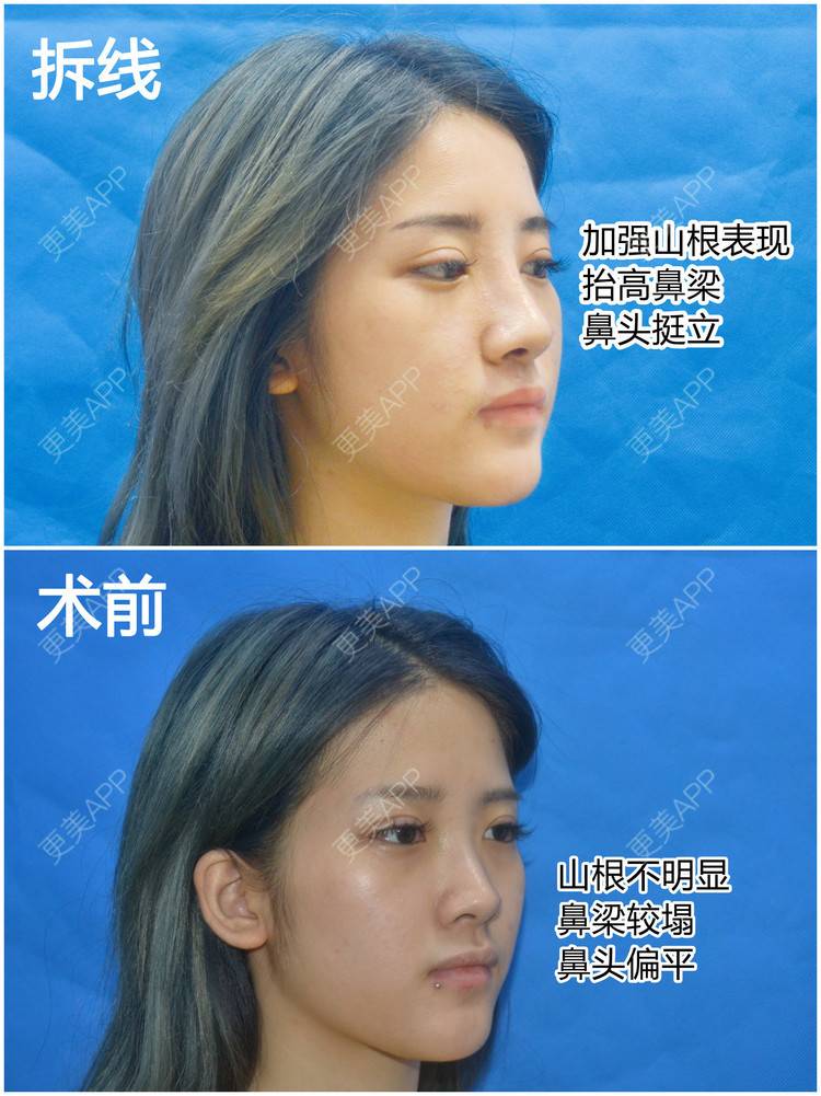 更美 - 李闯 医生的鼻中隔软骨隆鼻经验 | 鼻中隔软骨隆鼻