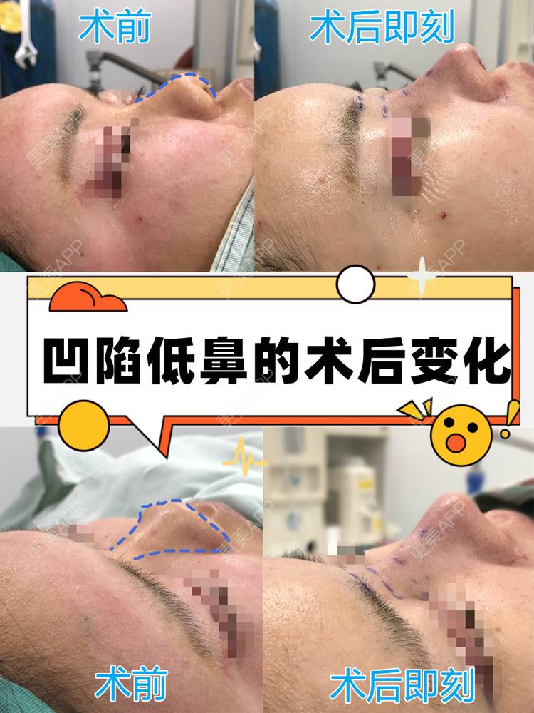 更美 - 李闯 医生的鼻部多项经验 | 鼻部多项