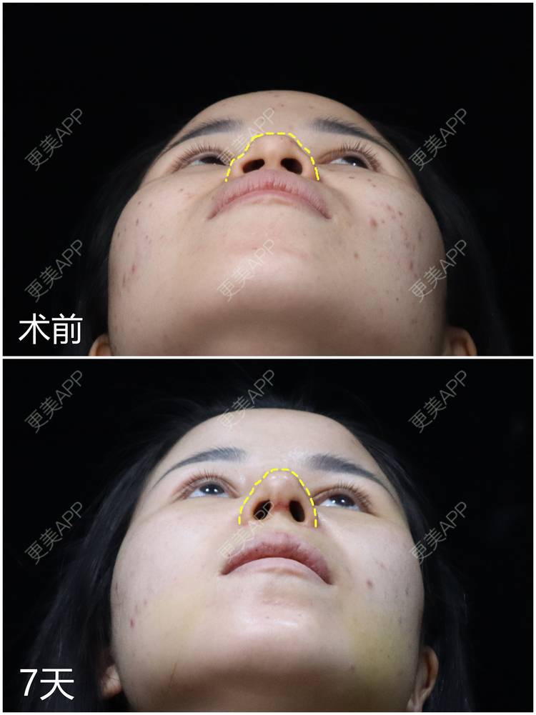 更美 - 李闯 医生的膨体隆鼻经验 | 膨体隆鼻