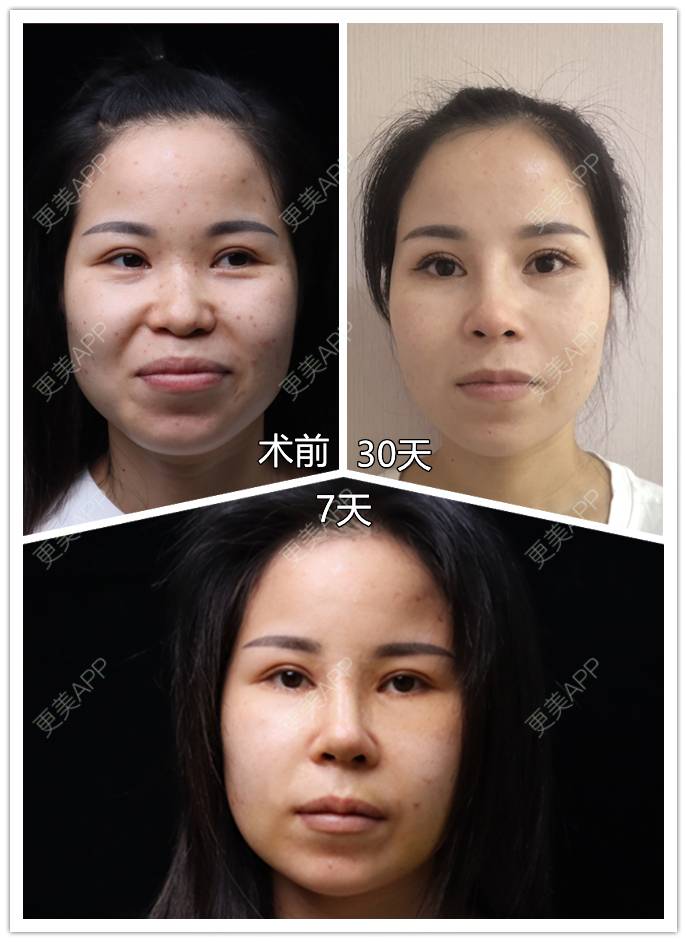 更美 - 李闯 医生的膨体隆鼻经验 | 膨体隆鼻