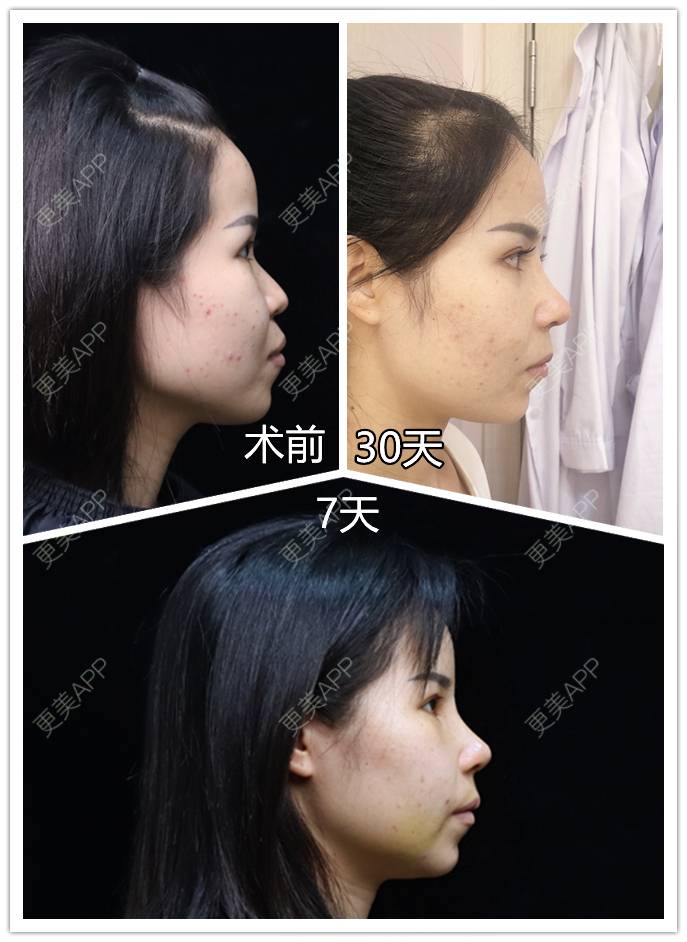 更美 - 李闯 医生的膨体隆鼻经验 | 膨体隆鼻