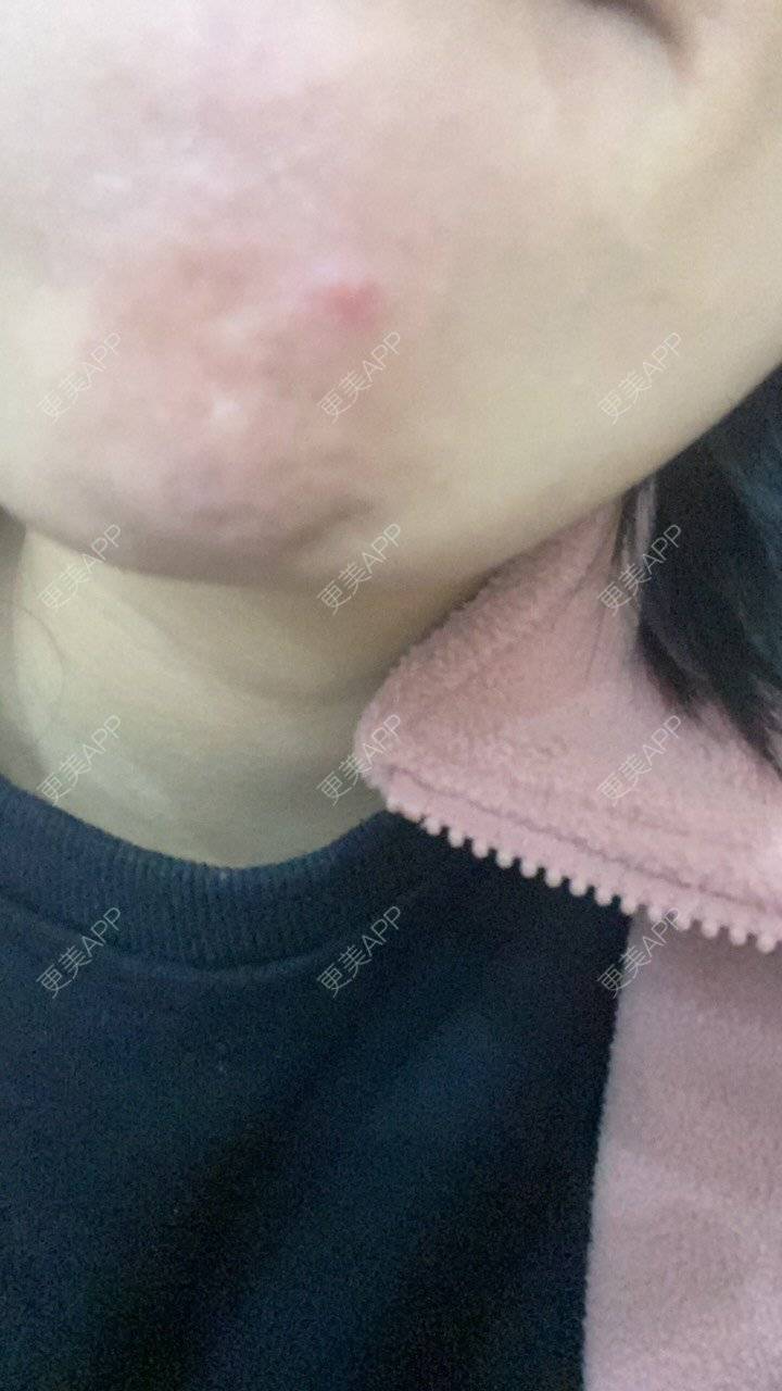 更美 - 西安禾悦医疗美容门诊部的玻尿酸下巴经验 | 玻尿酸下巴