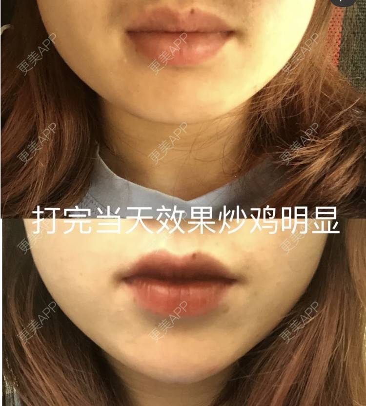 更美 - 西安禾悦医疗美容门诊部的玻尿酸下巴经验 | 玻尿酸下巴