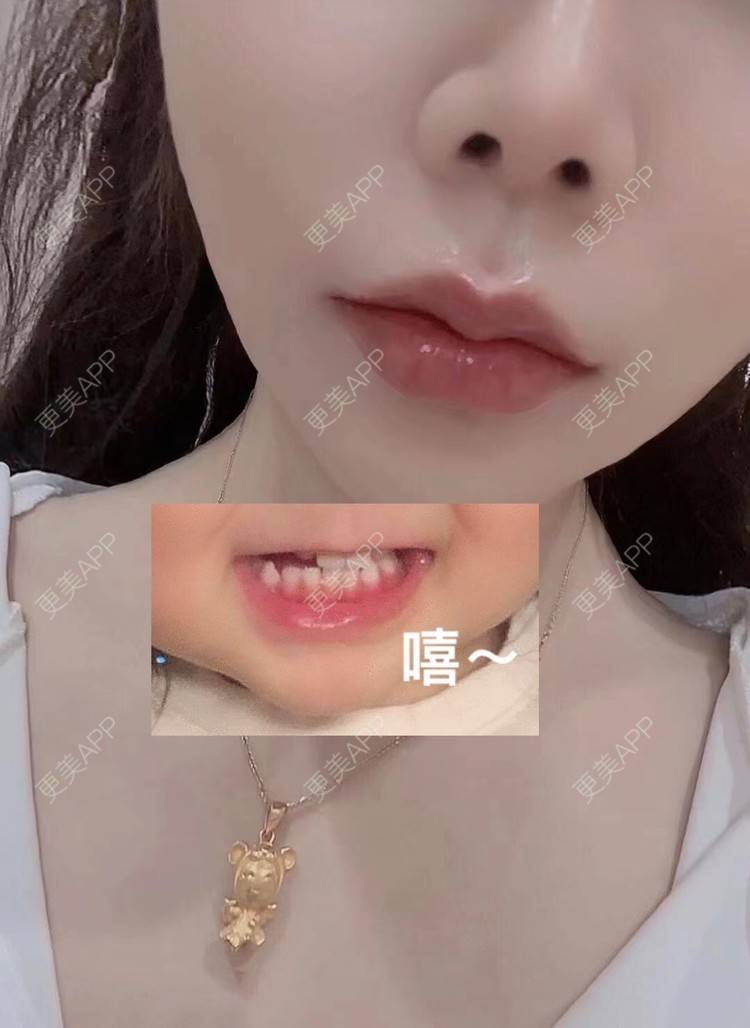 更美 - 西安禾悦医疗美容门诊部的玻尿酸下巴经验 | 玻尿酸下巴