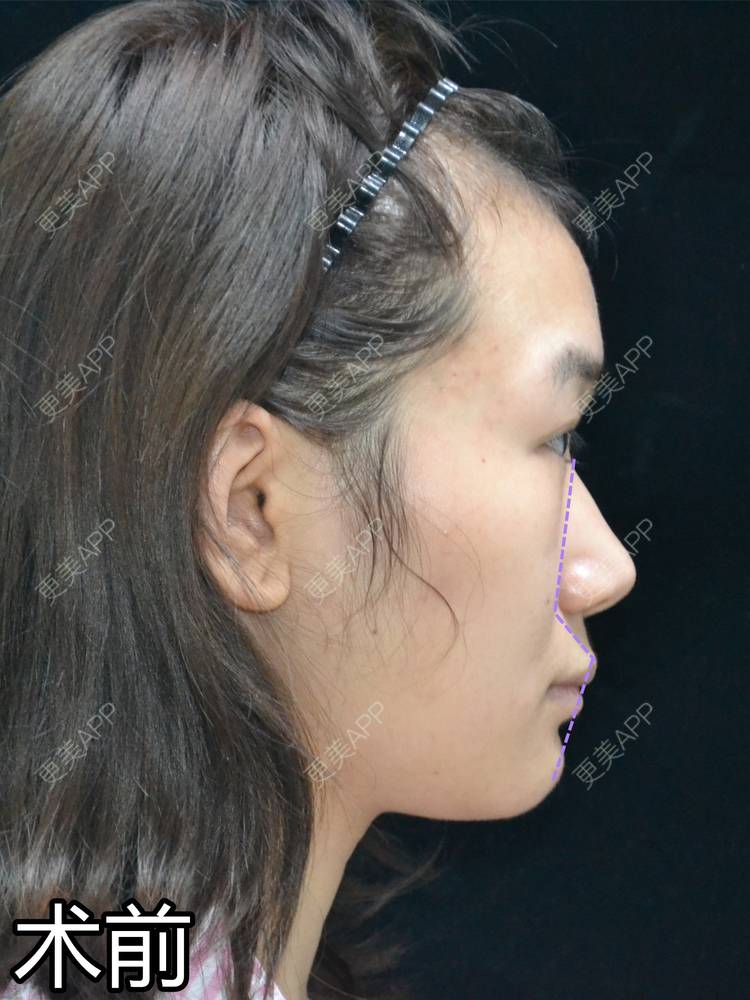 更美 - 李闯 医生的鼻骨内推经验 | 鼻骨内推