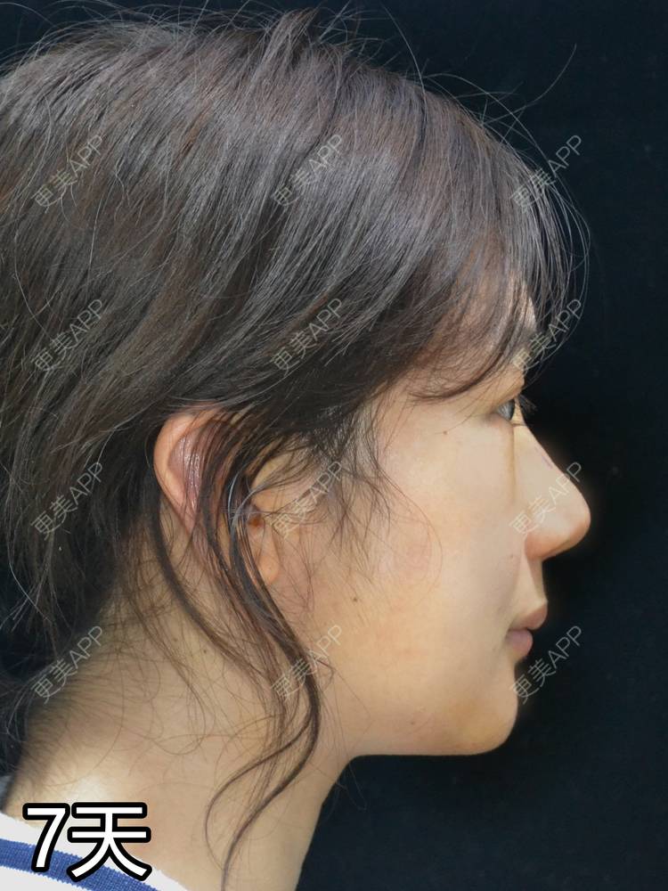 更美 - 李闯 医生的鼻骨内推经验 | 鼻骨内推