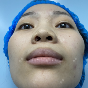 韩国栋【耳软骨隆鼻】双侧耳软骨鼻 膨体 另4项综合,结构派既稳又美