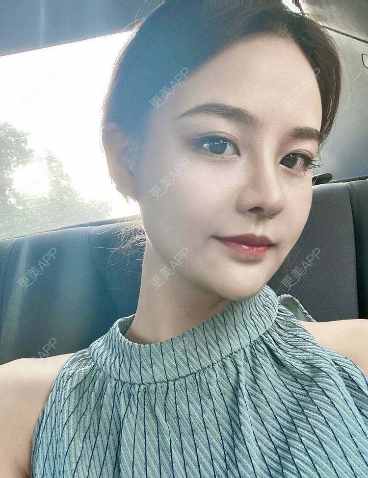 更美用户grlfac5xfu的膨体隆鼻日记