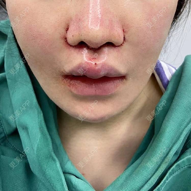 更美 - 我不贪吃的人中缩短日记 | 人中缩短 | 成都