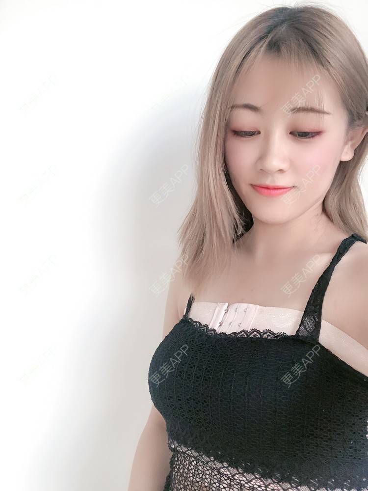 假体隆胸效果图_更美用户0spavpgdeu假体隆胸效果图_术后69天__更美