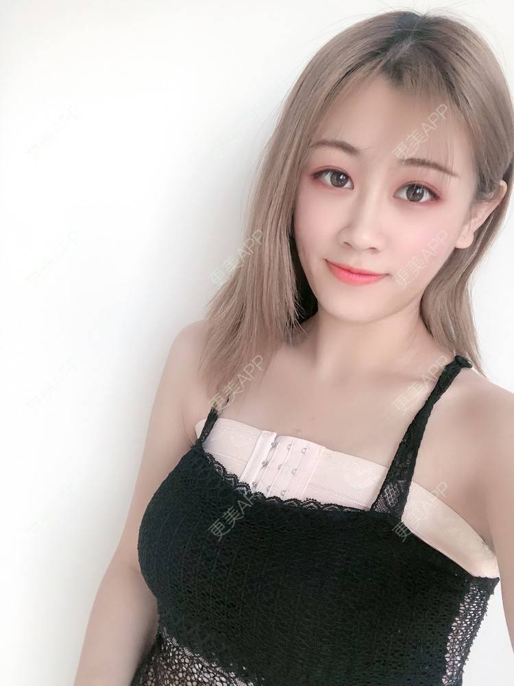 假体隆胸效果图_更美用户0spavpgdeu假体隆胸效果图_术后69天__更美
