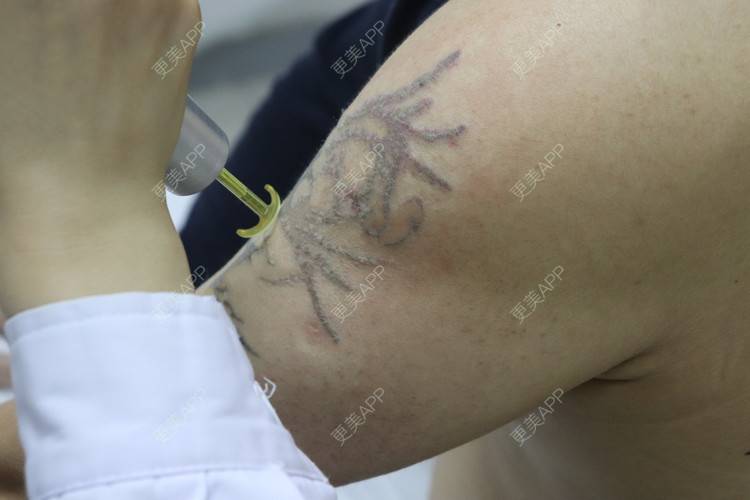 更美 - 更美用户9YJ0xyhXBy的激光洗纹身经验 | 激光洗纹身 | 皮秒洗纹身 | 超皮秒 | 深圳 | 激光淡斑 | 皮秒激光