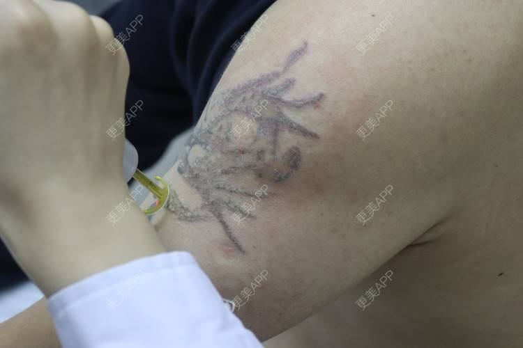 更美 - 更美用户9YJ0xyhXBy的激光洗纹身经验 | 激光洗纹身 | 皮秒洗纹身 | 超皮秒 | 深圳 | 激光淡斑 | 皮秒激光