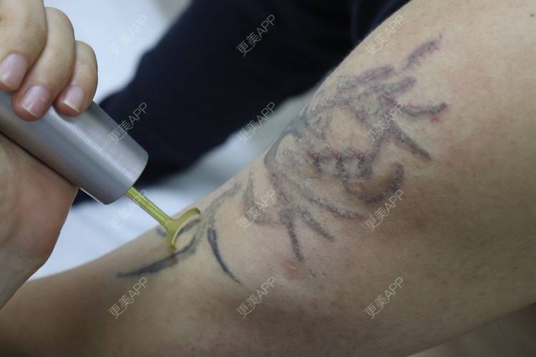 更美 - 更美用户9YJ0xyhXBy的激光洗纹身经验 | 激光洗纹身 | 皮秒洗纹身 | 超皮秒 | 深圳 | 激光淡斑 | 皮秒激光