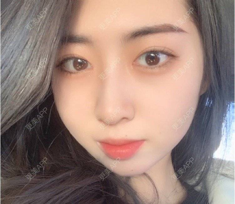 更美 - 刘金丹 医生的定点双眼皮经验 | 定点双眼皮 | 南昌