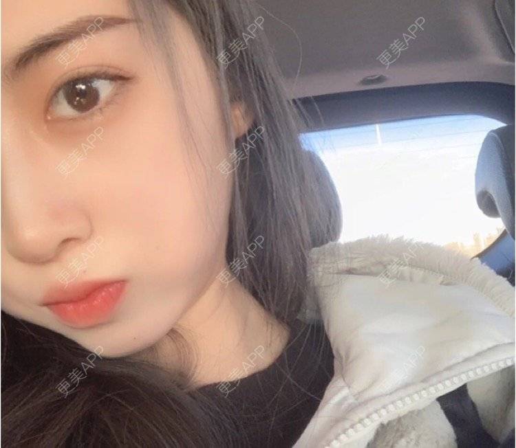 更美 - 刘金丹 医生的定点双眼皮经验 | 定点双眼皮 | 南昌