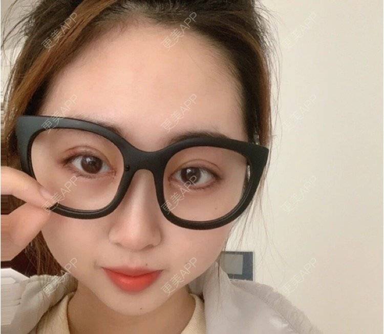 更美 - 刘金丹 医生的定点双眼皮经验 | 定点双眼皮 | 南昌