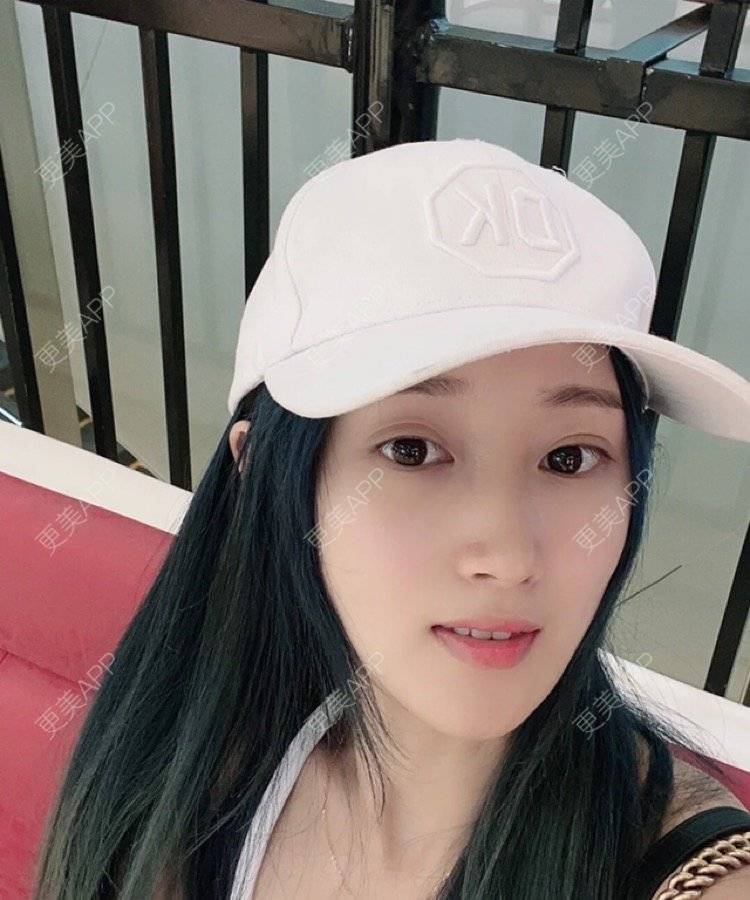 更美 - 刘金丹 医生的定点双眼皮经验 | 定点双眼皮 | 南昌