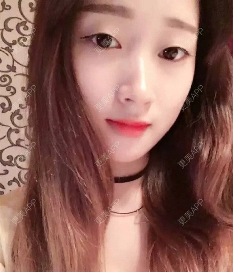 更美 - 刘金丹 医生的定点双眼皮经验 | 定点双眼皮 | 南昌