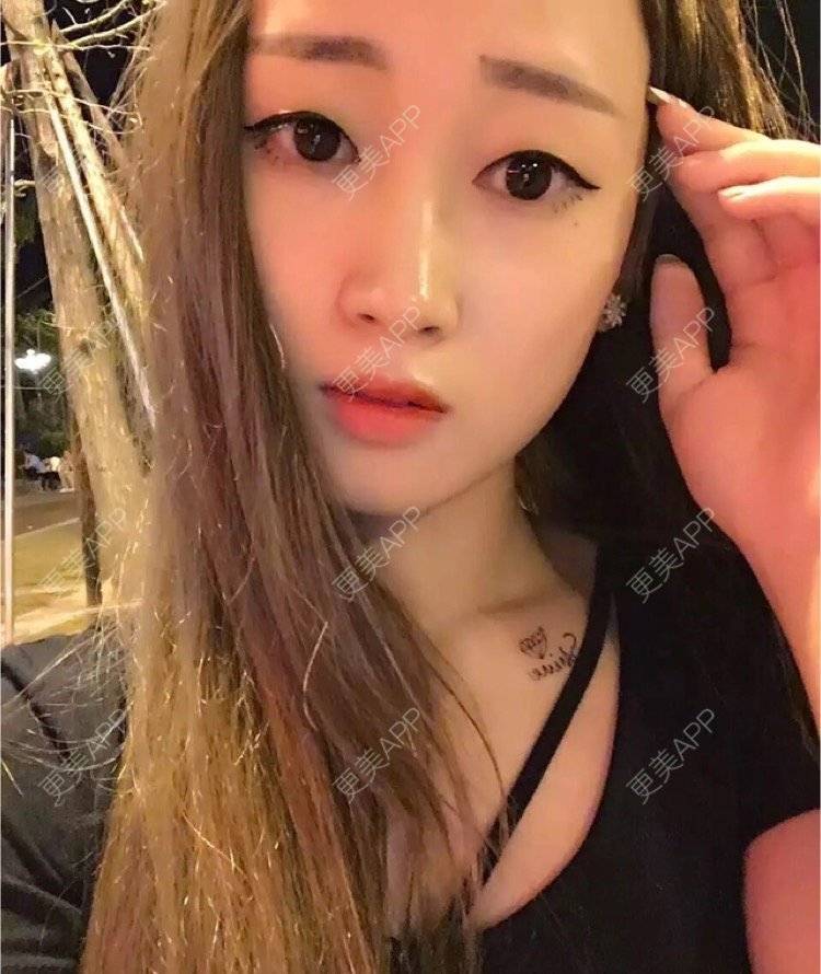 更美 - 刘金丹 医生的定点双眼皮经验 | 定点双眼皮 | 南昌